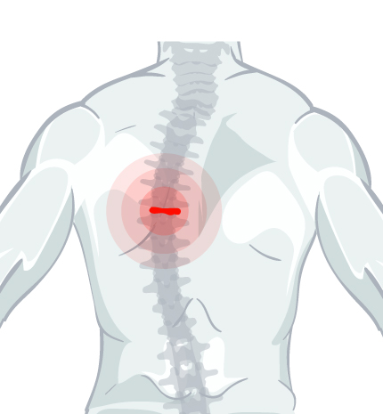 Hernia Discal