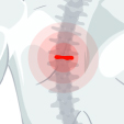 Hernia Discal